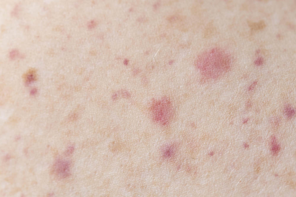 Spálová angína – příznaky, komplikace a léčba